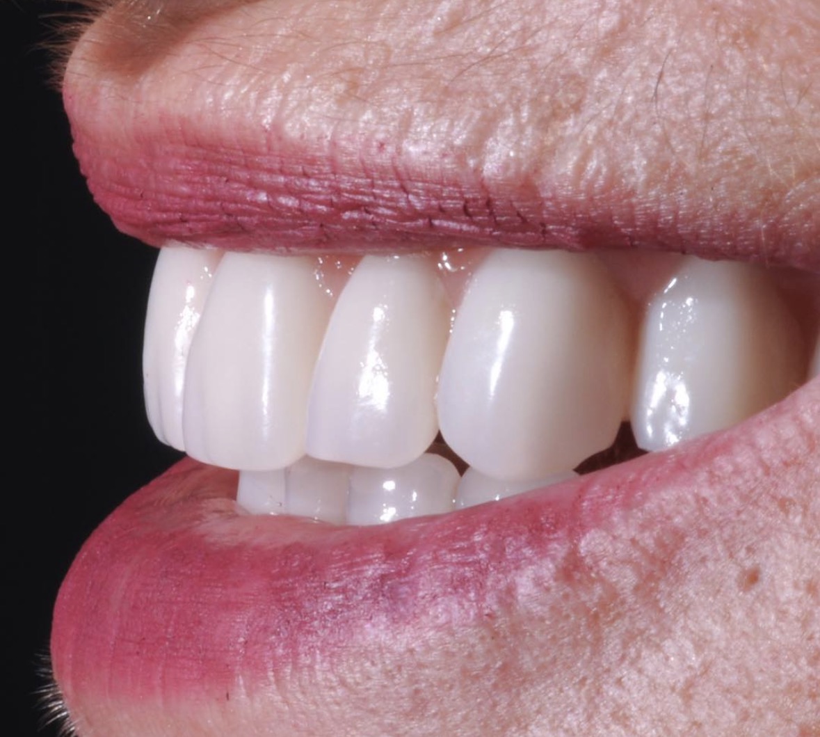 Sorriso natural após reabilitação